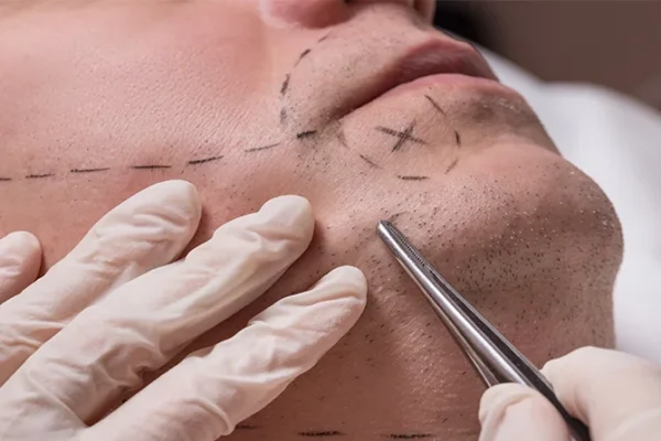 Beard Transplant Miami