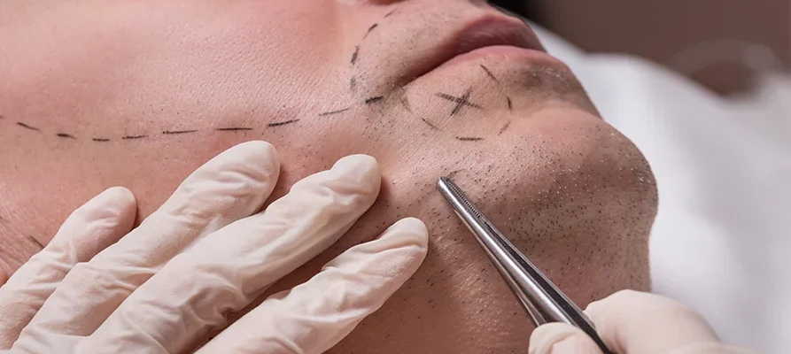 Beard Transplant Miami