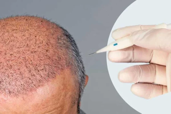 DHI Hair Transplant Miami