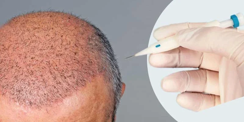 DHI hair transplant miami