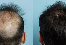 DHI vs FUE in Miami: Which Hair Transplant Method Fits Your Hair Loss Pattern?