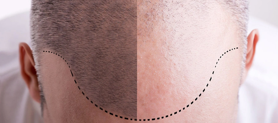 hair transplant miami