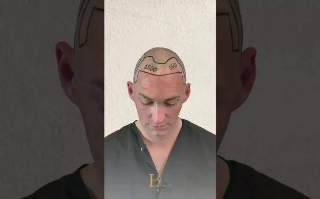 HairTransplant Result-Before&After