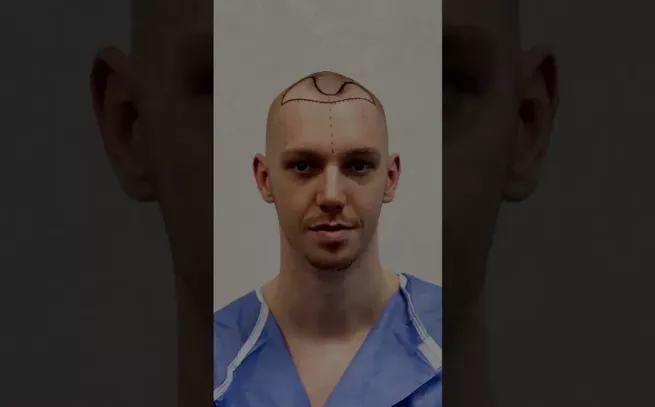 Hair Transplant Result -Before&After