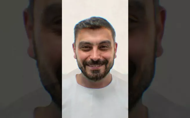 Hair Transplant Result -Before&After